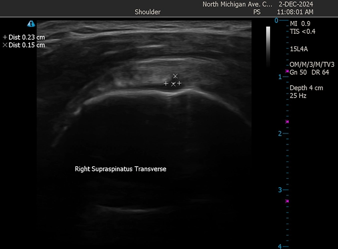 Regenerative Treatments Downtown Chicago IL Rotator Tear 1