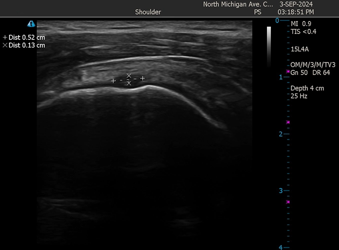 Regenerative Treatments Downtown Chicago IL Rotator Tear